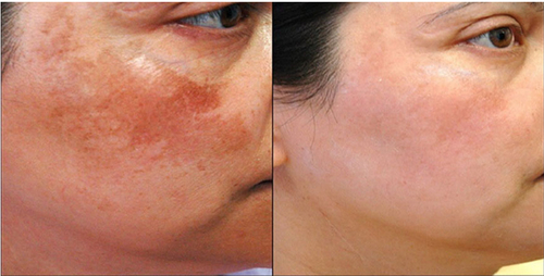 Melasma Treatment