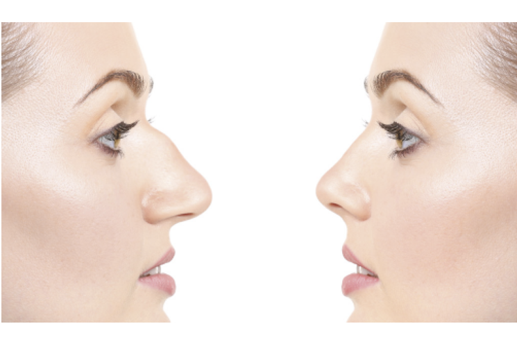 Rhinoplasty