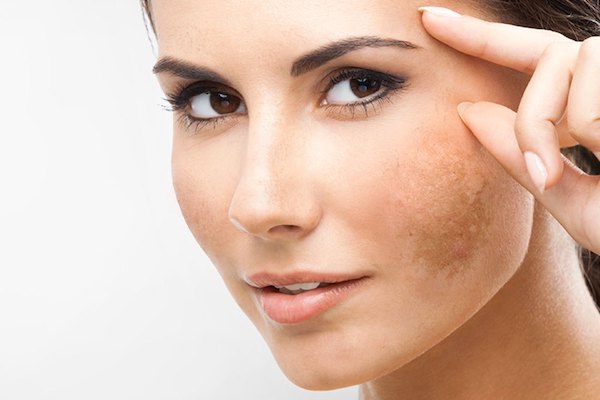 Pigmentation and Melasma